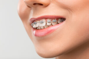 Braces on a Budget: Transform Your Smile Without Overspending