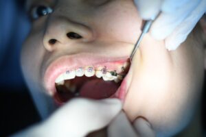 The Stages of Dental Braces Treatment: What to Expect