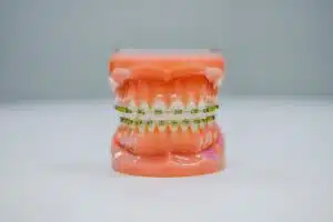 The Stages of Dental Braces Treatment: What to Expect