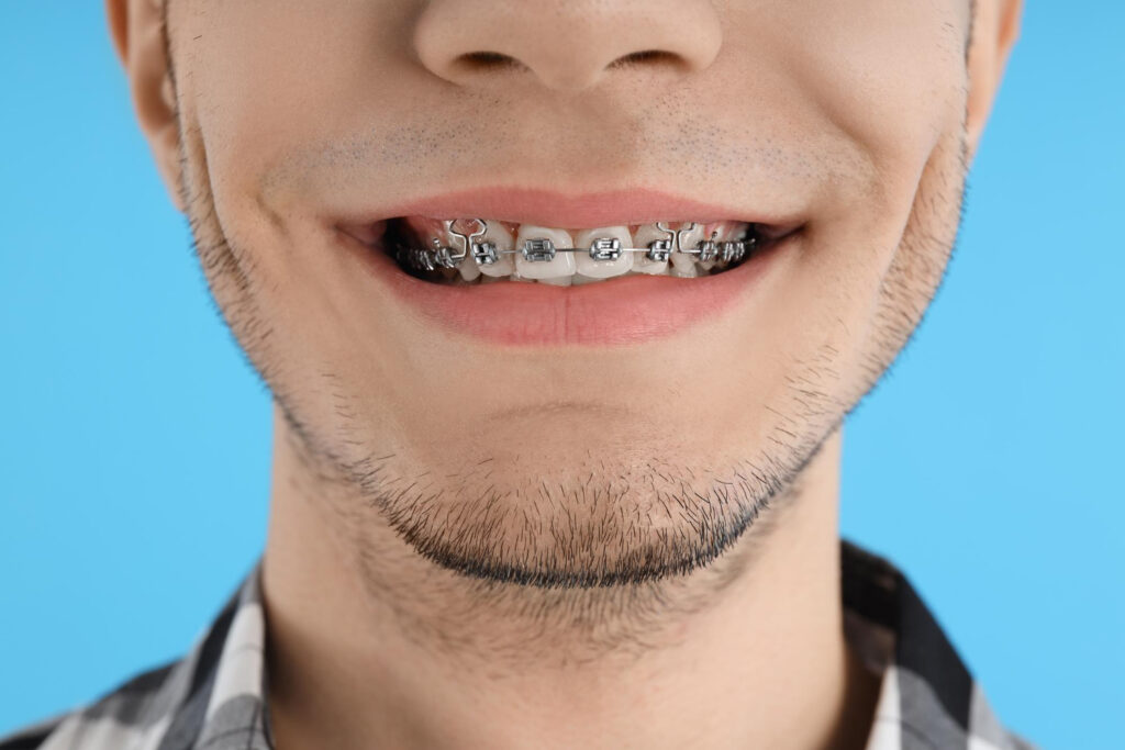 5 Hidden Benefits of Wearing Braces That Will Surprise You