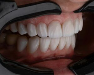 Tooth Pocket Treatment Options That Actually Work