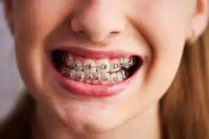 Braces for Teens: Must-Know Signs, Costs, and Options