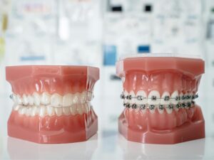 Bite Correction vs. Cosmetic Straightening: Expert Advice for Lasting Results