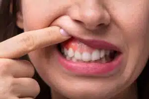 Close-up of a person pulling back their lip to show braces and gum swelling along the upper gumline