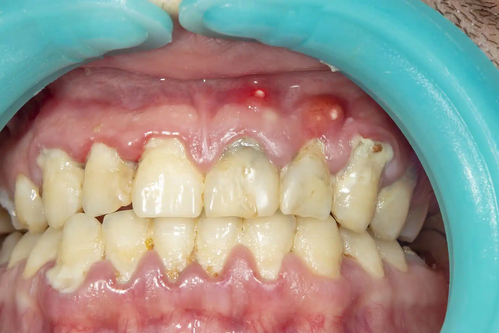 Close-up of teeth and gums showing gum swelling from braces with visible redness and plaque buildup