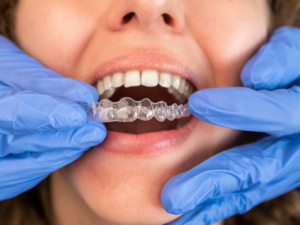 Woman holding clear aligners and a toothbrush demonstrating Invisalign care and maintenance habits