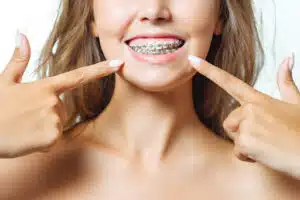 DIY Teeth Straightening