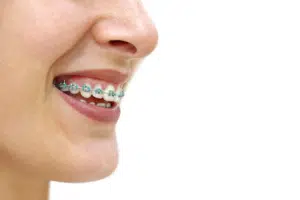 Close-up of patient smiling with braces after braces adjustment pain subsides