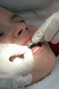 Orthodontist adjusting brackets during an orthodontic adjustment appointment