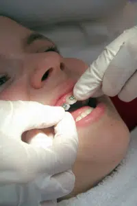 Orthodontist adjusting brackets during an orthodontic adjustment appointment