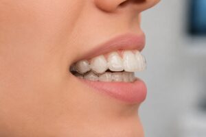 patient with an overbite wearing Invisalign